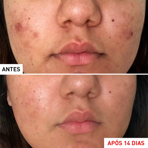 CENTELLA ACNE CARE - Fluido anti-imperfeições